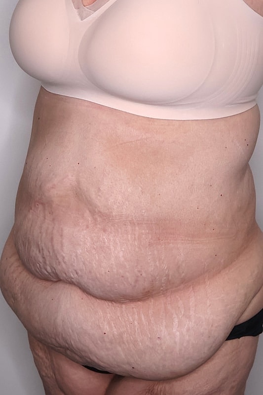 Tummy Tuck Before & After