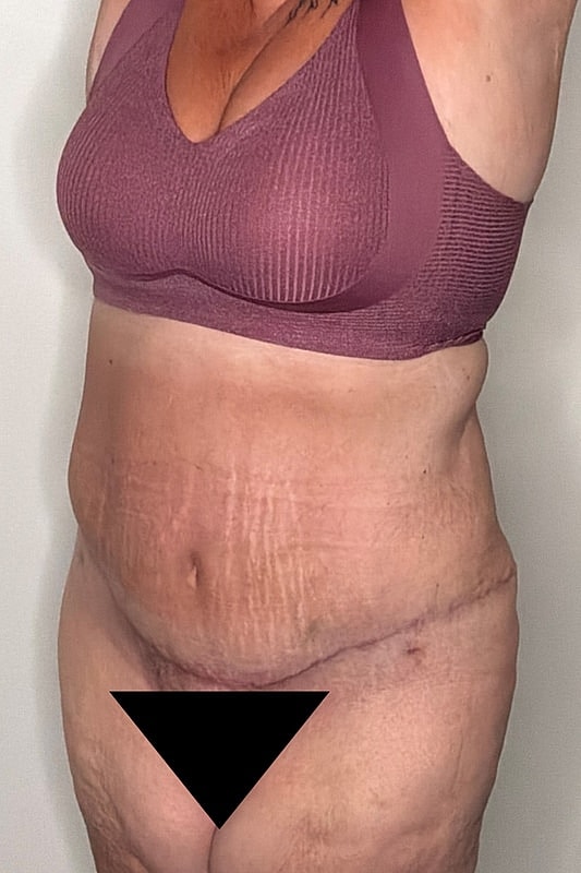 Tummy Tuck Before & After