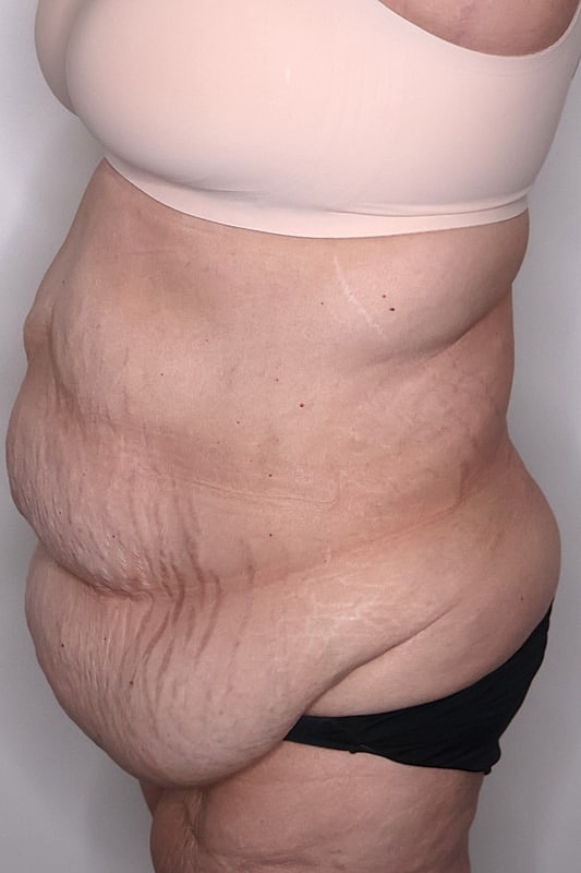 Tummy Tuck Before & After