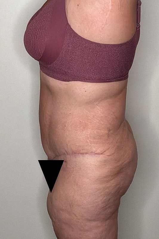 Tummy Tuck Before & After
