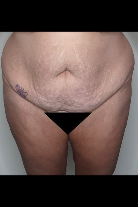 Tummy Tuck Before & After