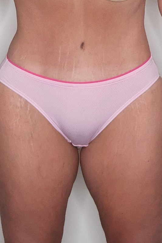 Tummy Tuck Before & After