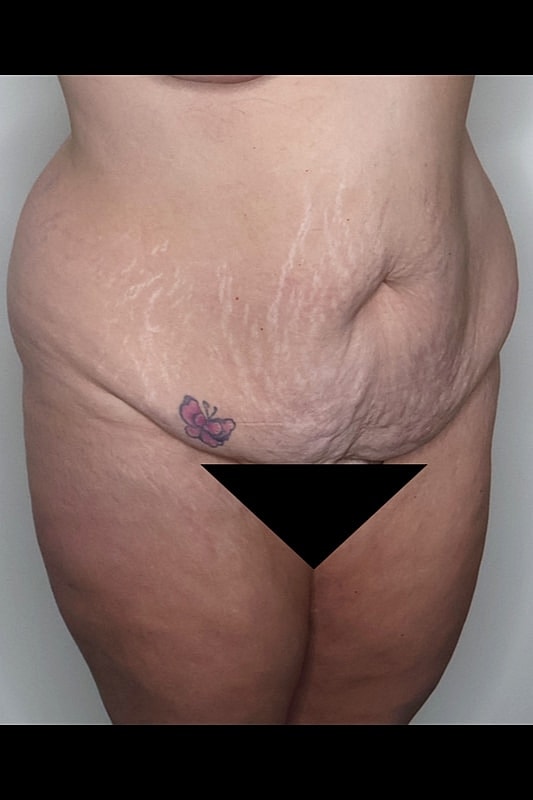 Tummy Tuck Before & After