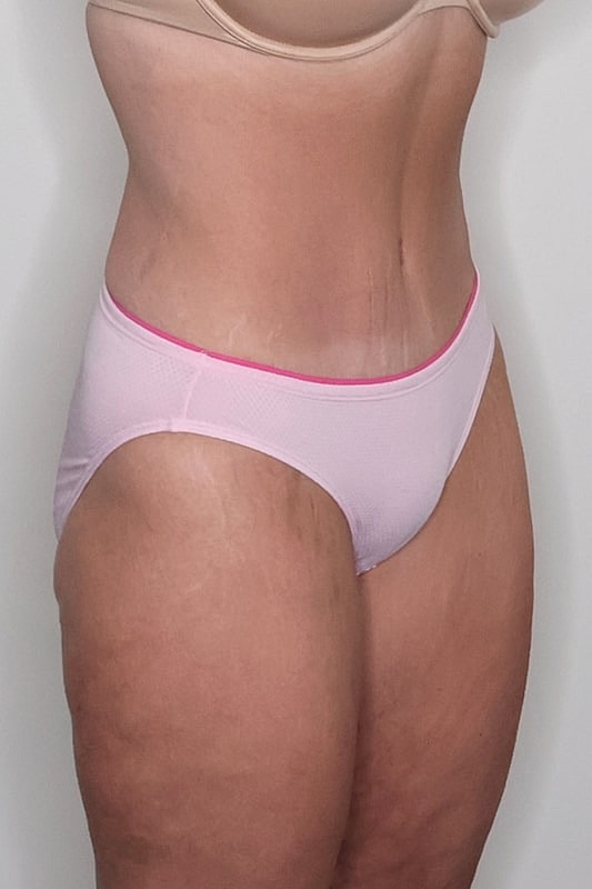 Tummy Tuck Before & After