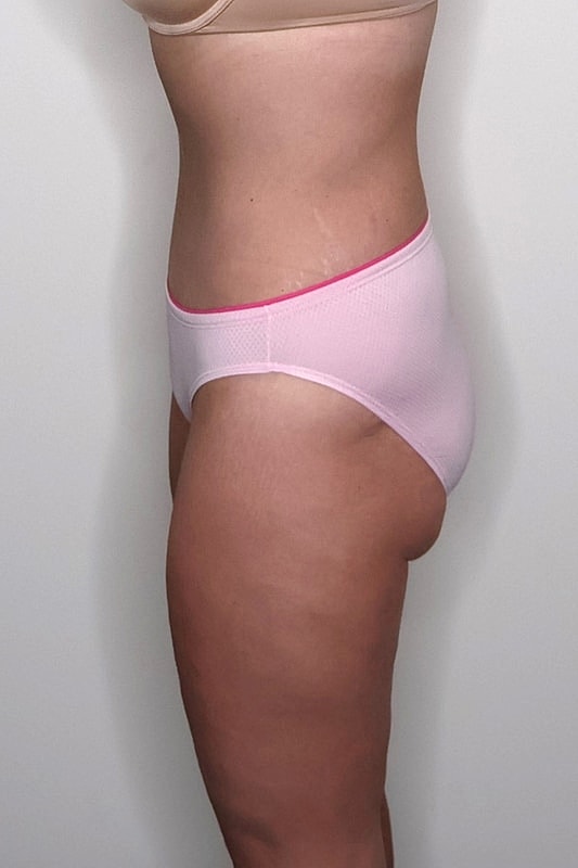 Tummy Tuck Before & After