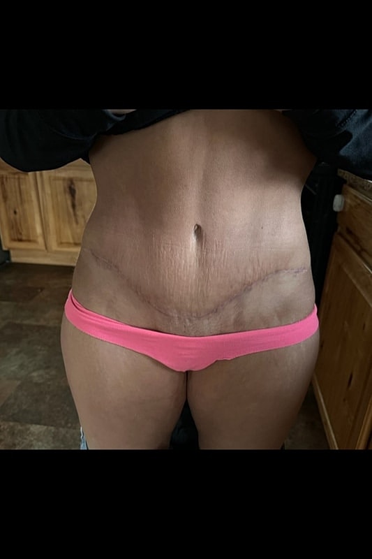 Tummy Tuck Before & After