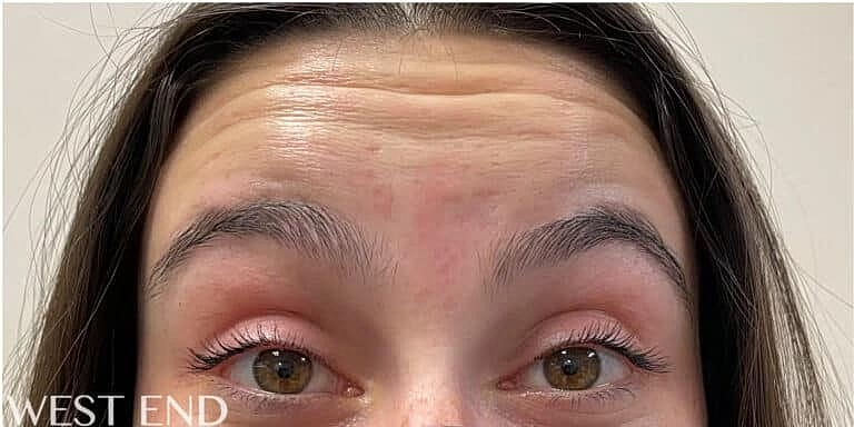 Dysport Before & After