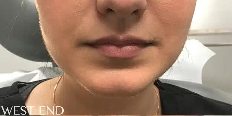 Dysport Before & After
