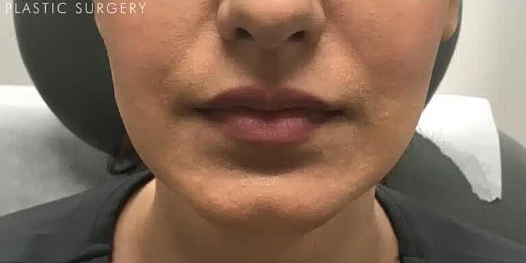 Dysport Before & After