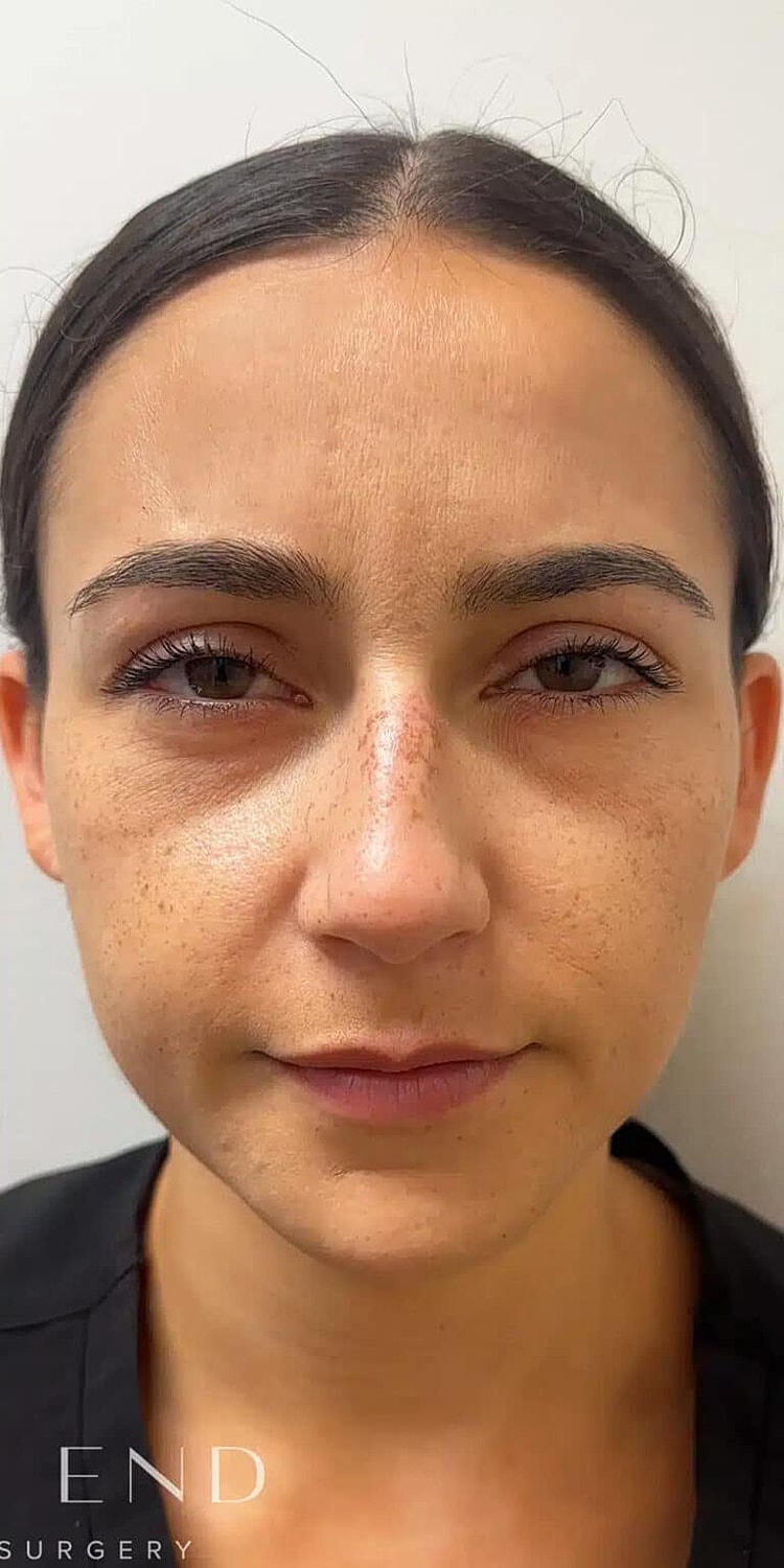 Dysport Before & After