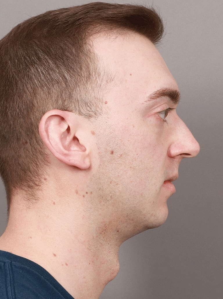 Cheek Implants Before & After