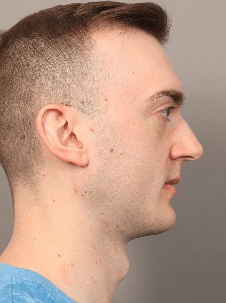 Cheek Implants Before & After