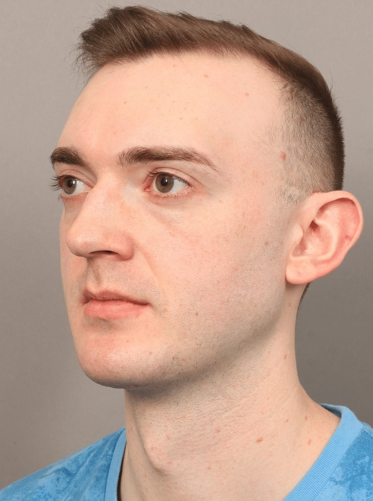 Cheek Implants Before & After