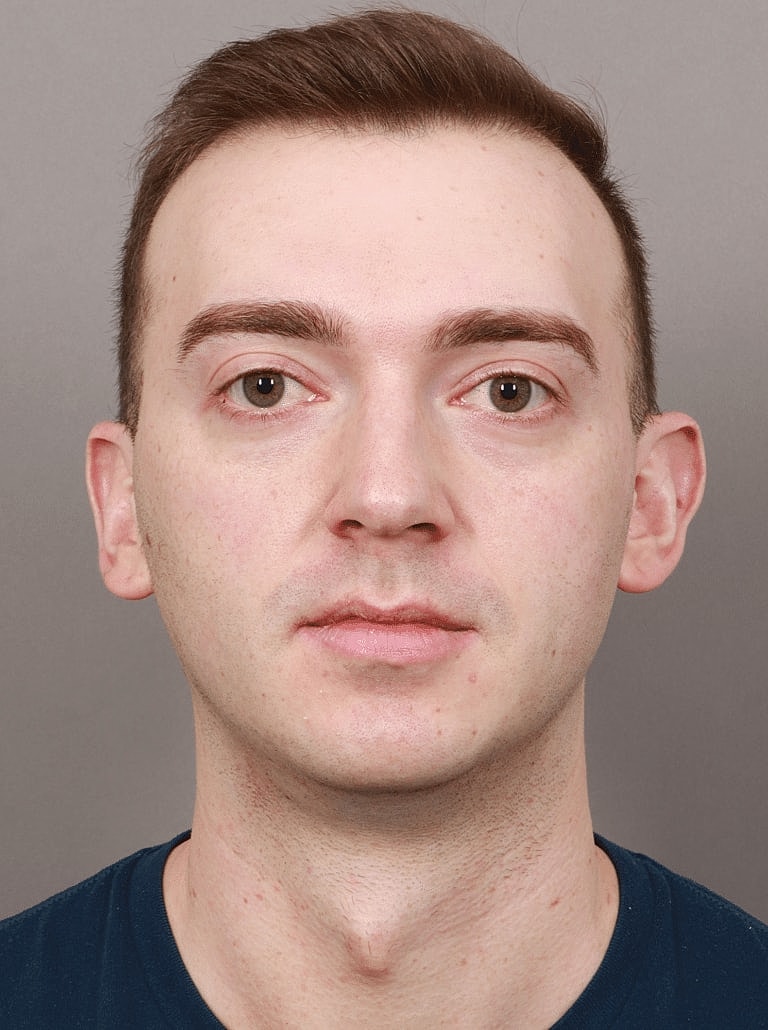 Cheek Implants Before & After