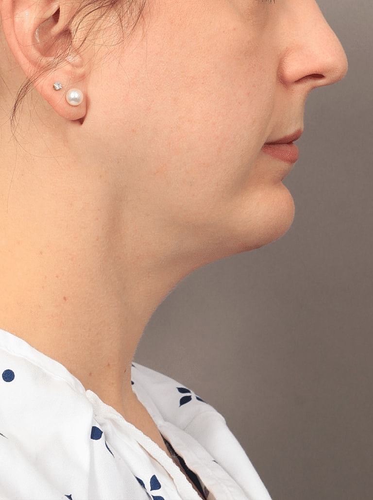 Cheek Implants Before & After