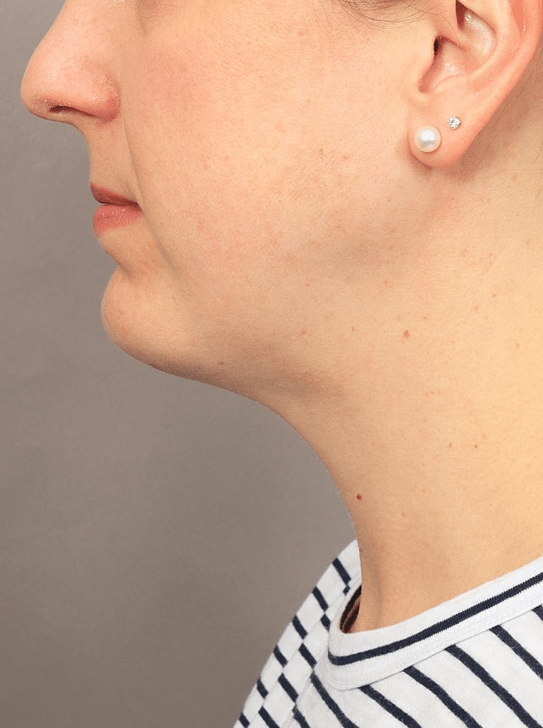 Cheek Implants Before & After