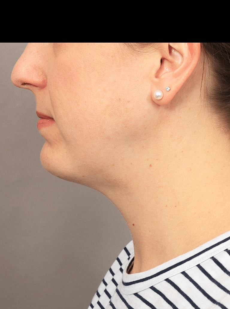 Cheek Implants Before & After