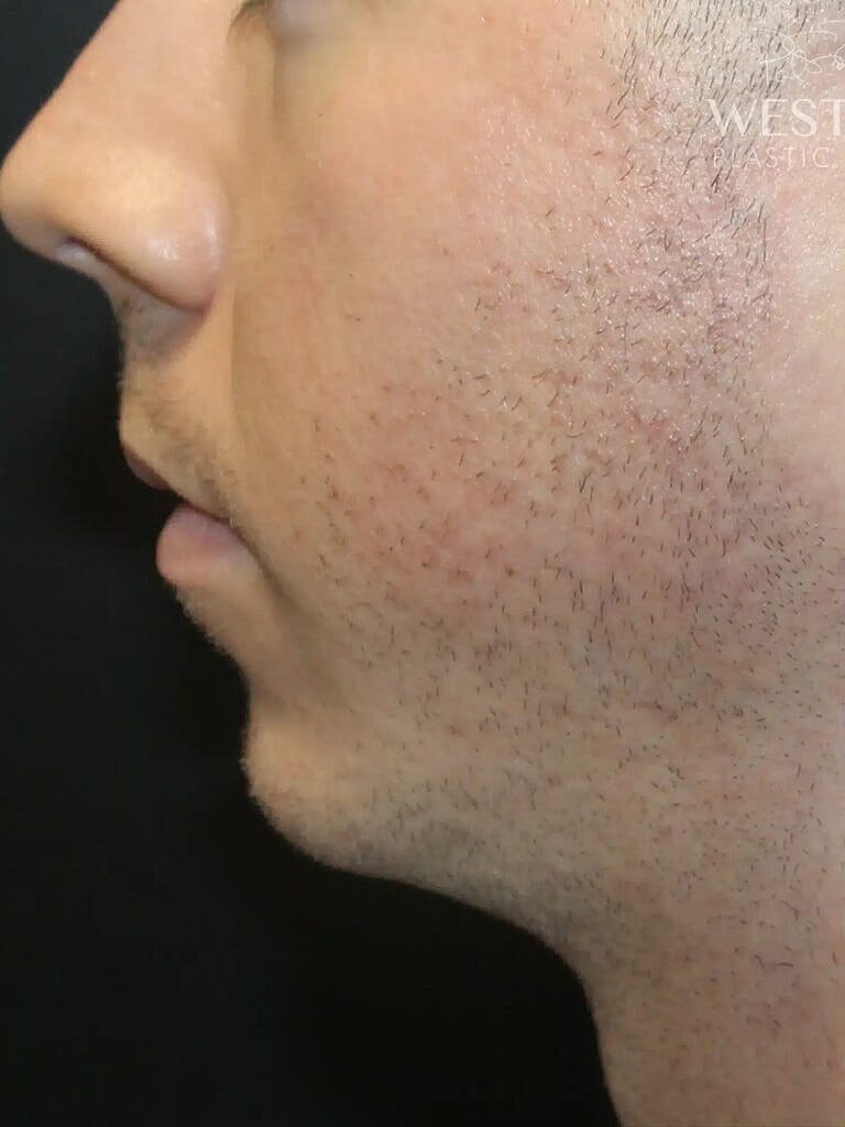 Cheek Implants Before & After