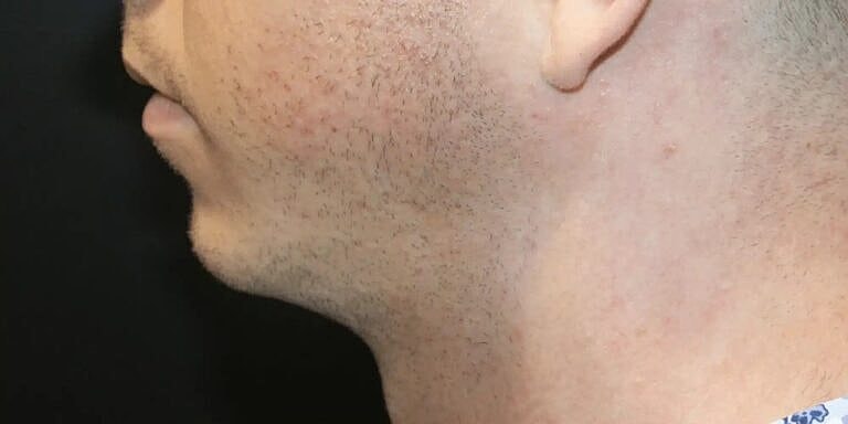 Cheek Implants Before & After