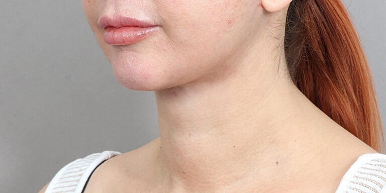 Neck Lift Before & After