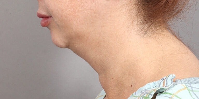 Neck Lift Before & After