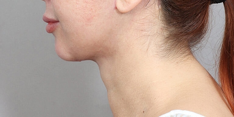 Neck Lift Before & After