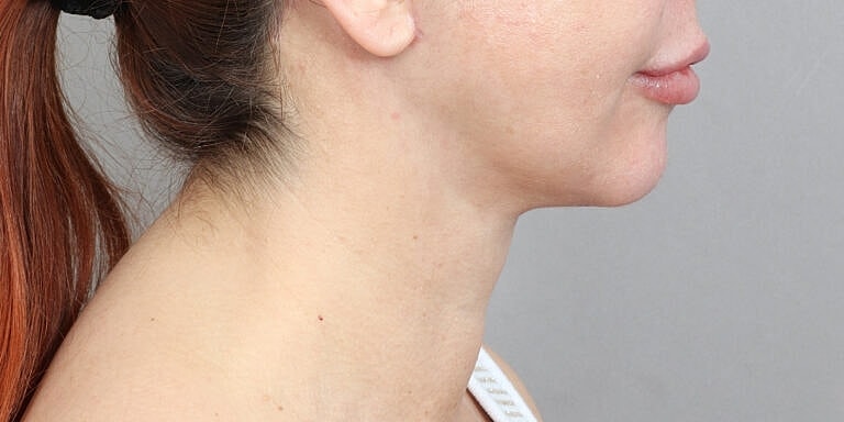 Neck Lift Before & After
