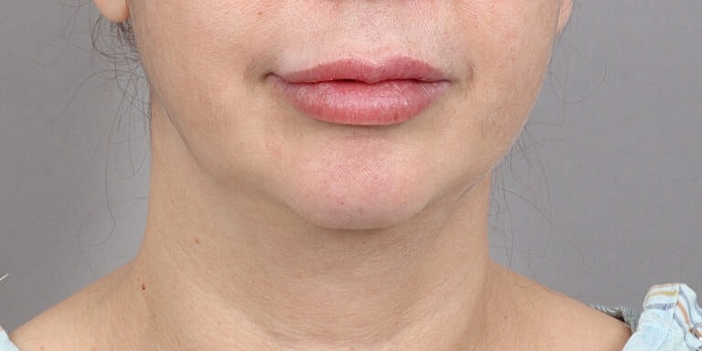 Neck Lift Before & After