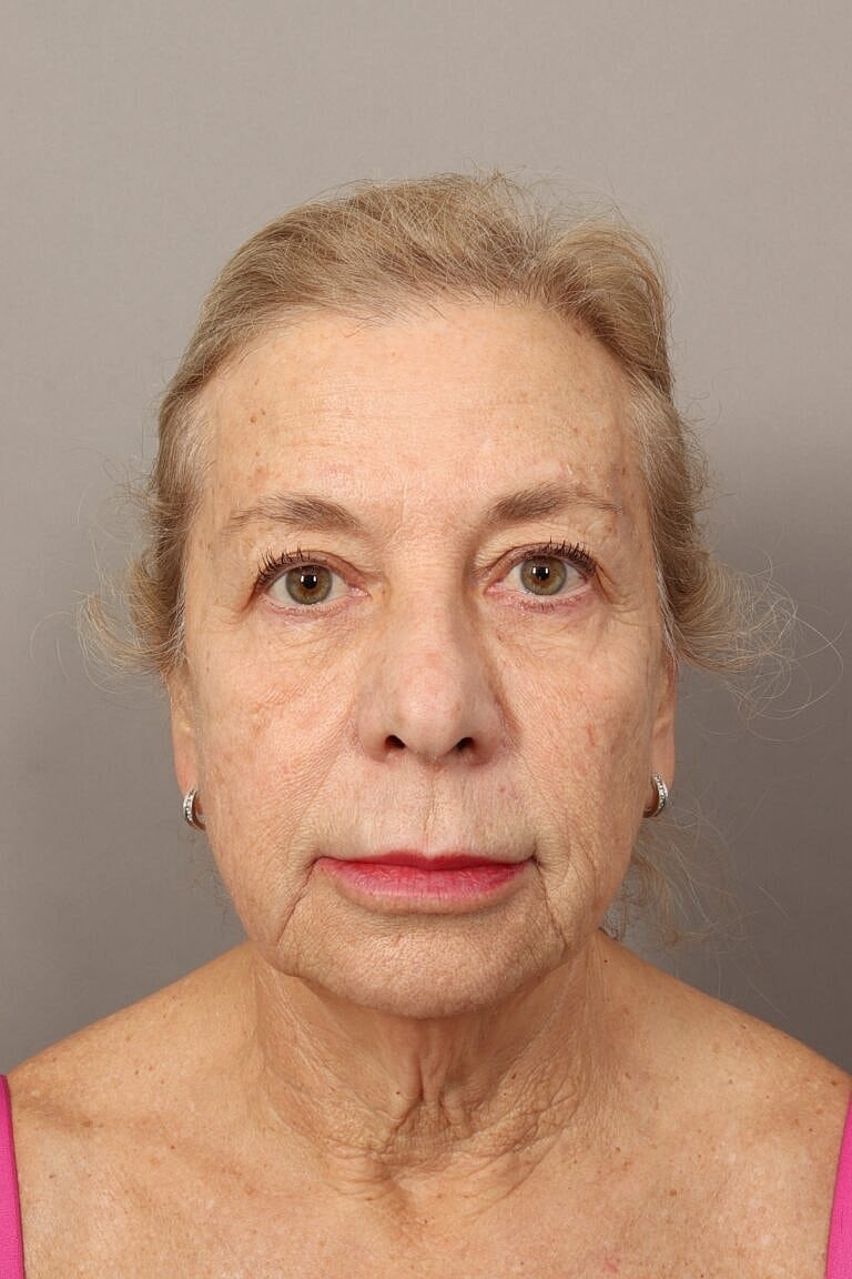 Neck Lift Before & After