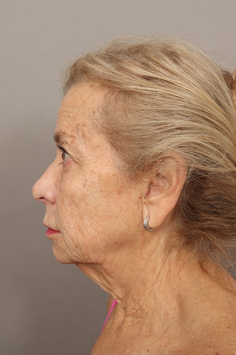 Neck Lift Before & After