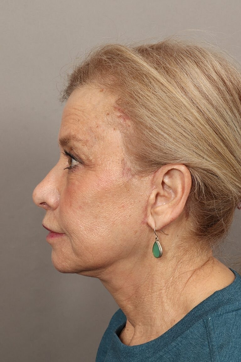 Neck Lift Before & After