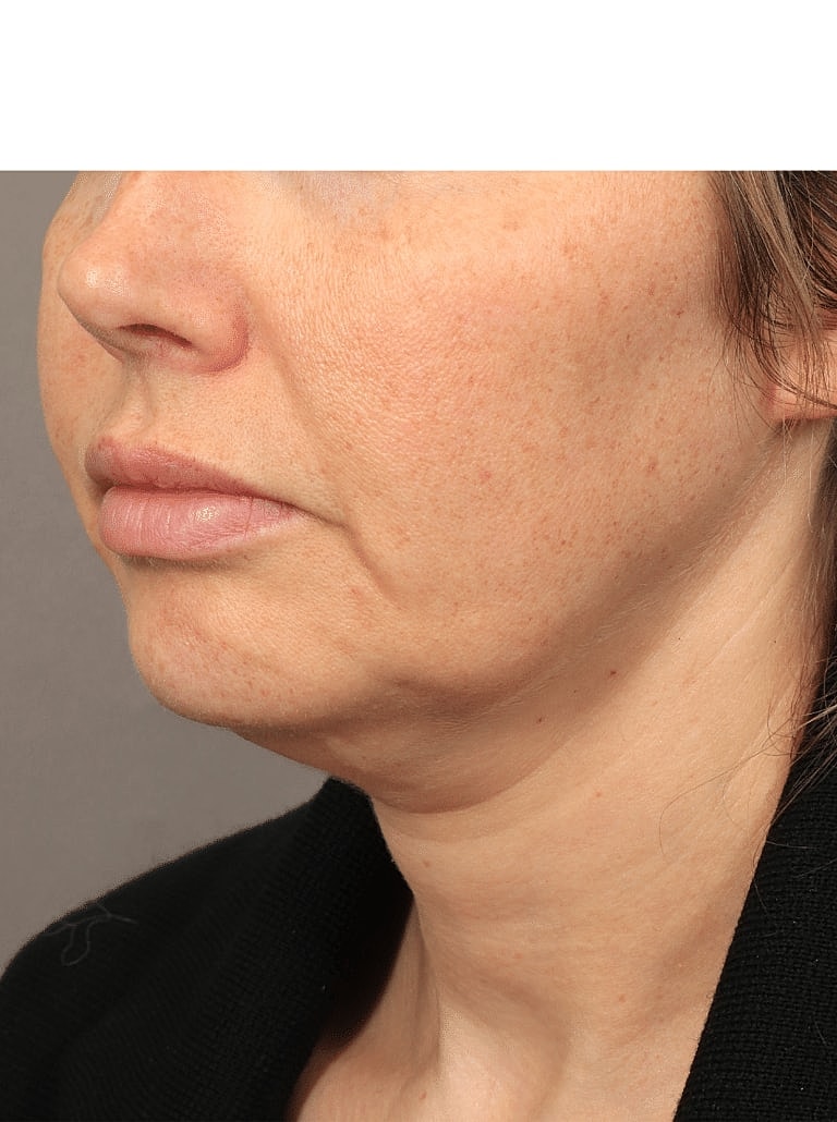 Neck Lift Before & After