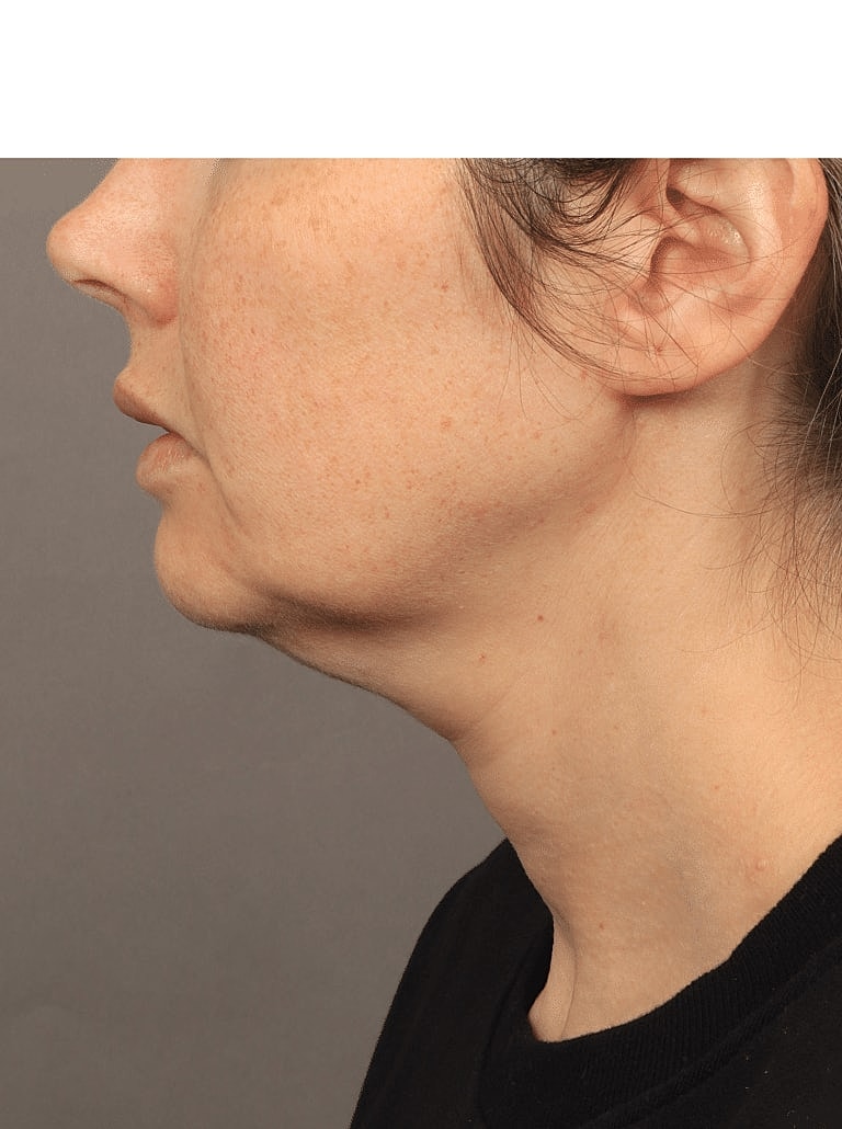 Neck Lift Before & After