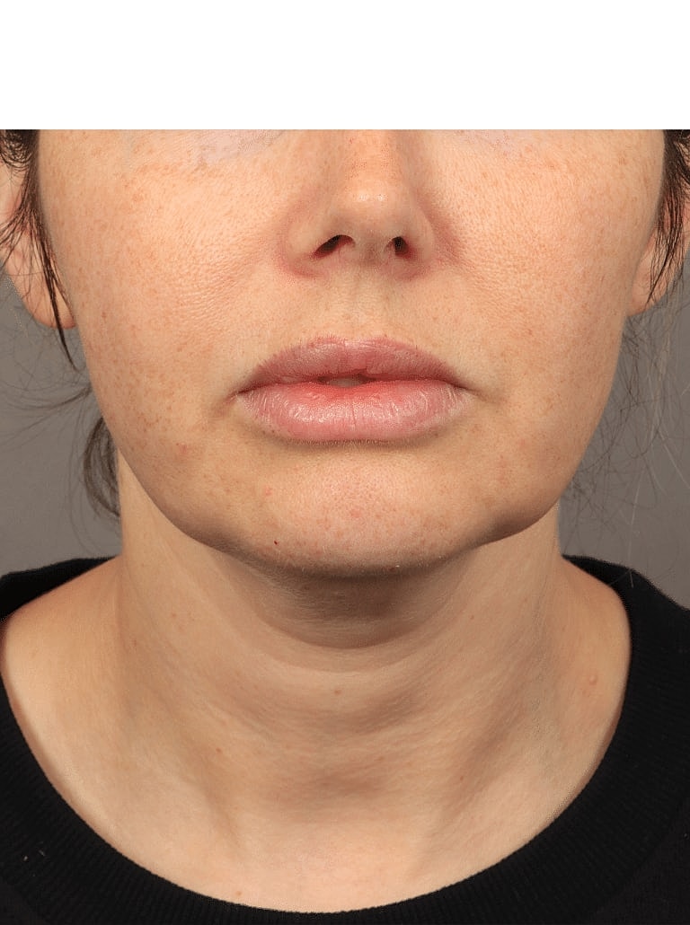 Neck Lift Before & After