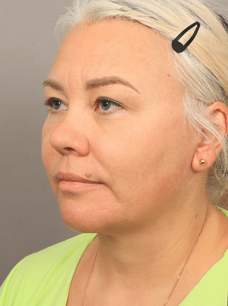 Neck Lift Before & After