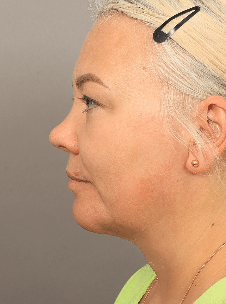 Neck Lift Before & After