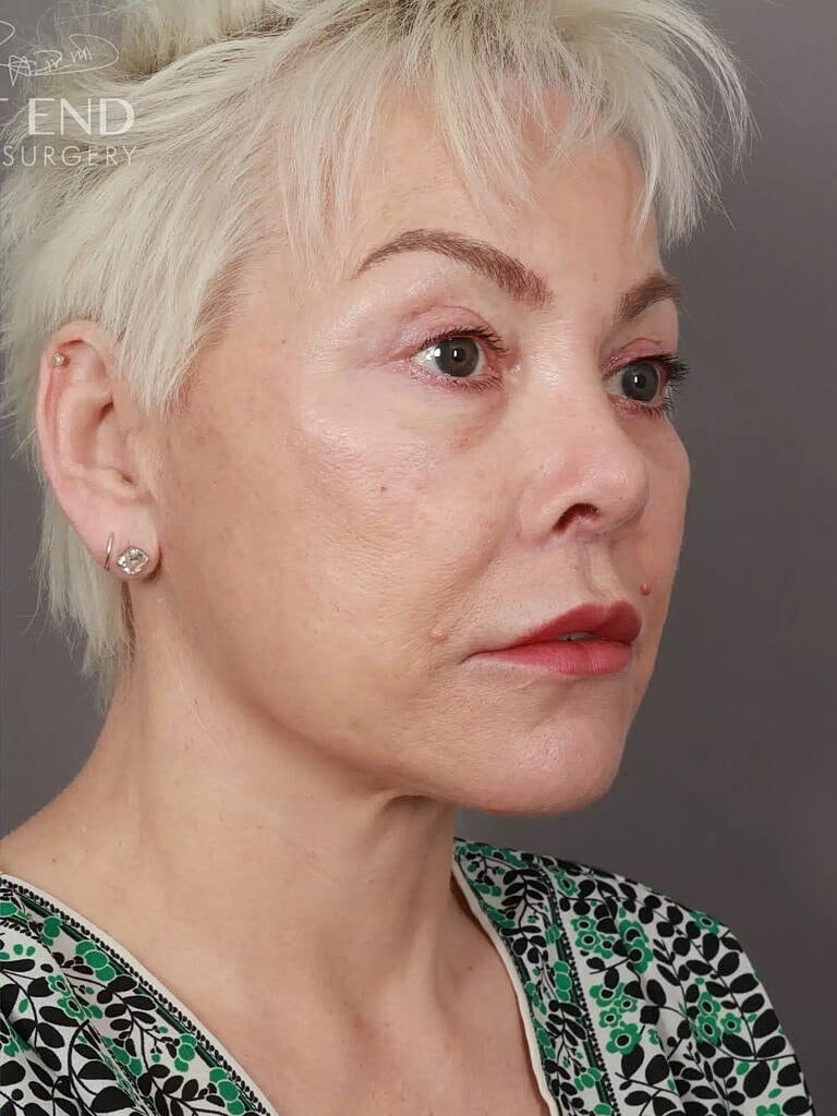 Neck Lift Before & After