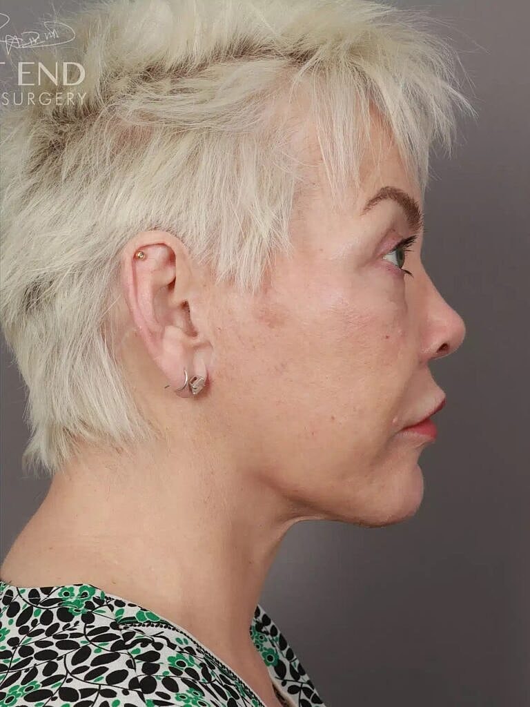 Neck Lift Before & After
