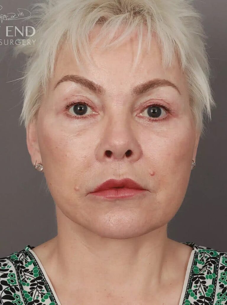 Neck Lift Before & After