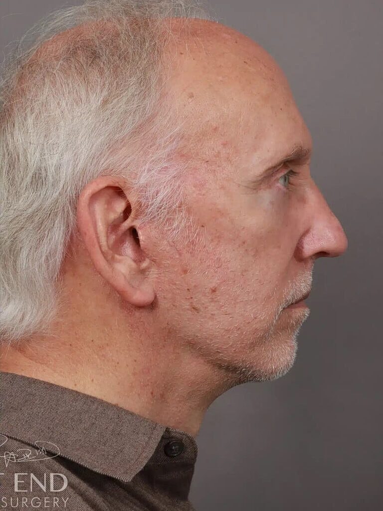 Neck Lift Before & After