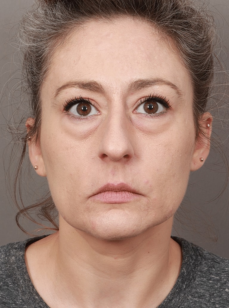 Neck Lift Before & After
