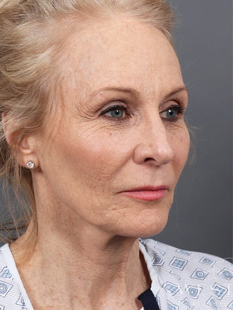 Neck Lift Before & After