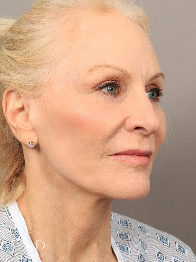Neck Lift Before & After