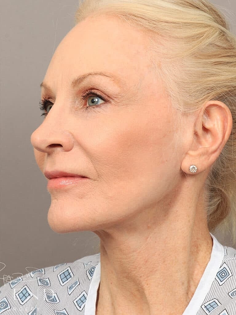 Neck Lift Before & After