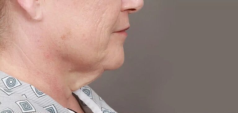 Neck Lift Before & After