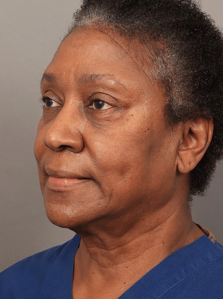 Neck Lift Before & After