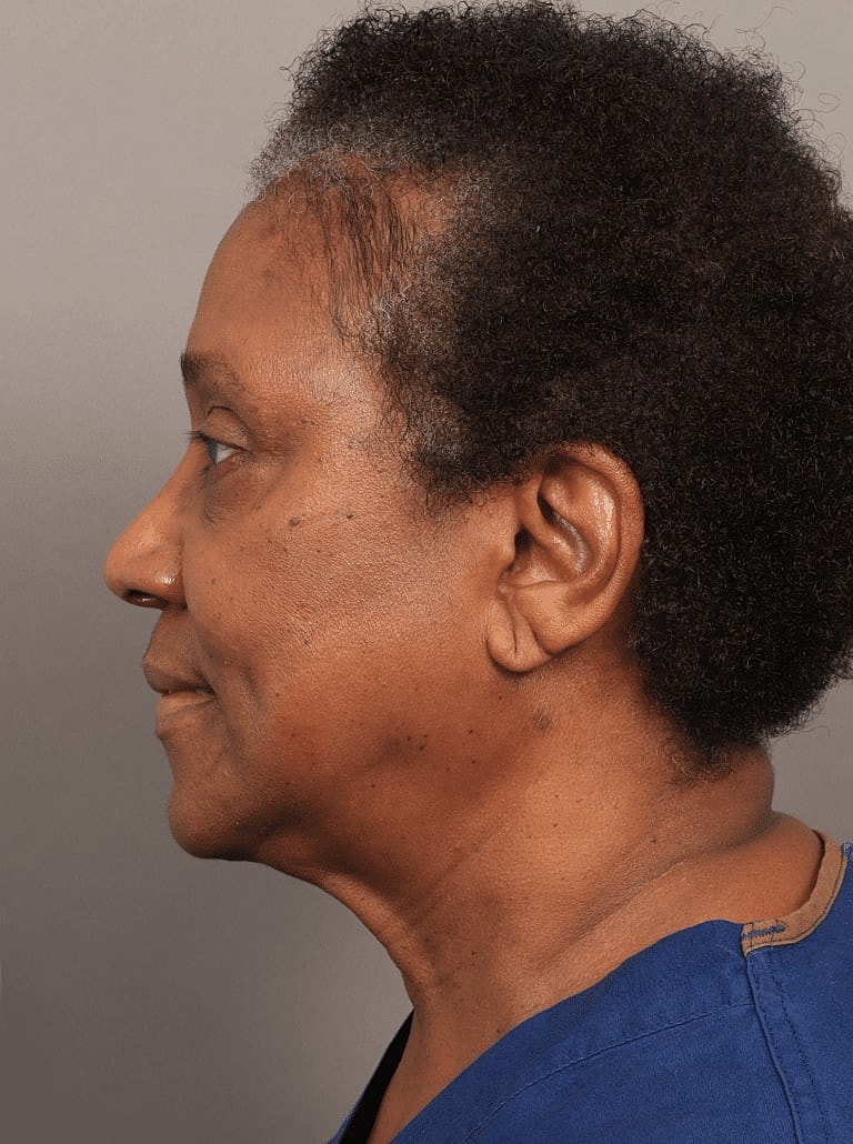Neck Lift Before & After
