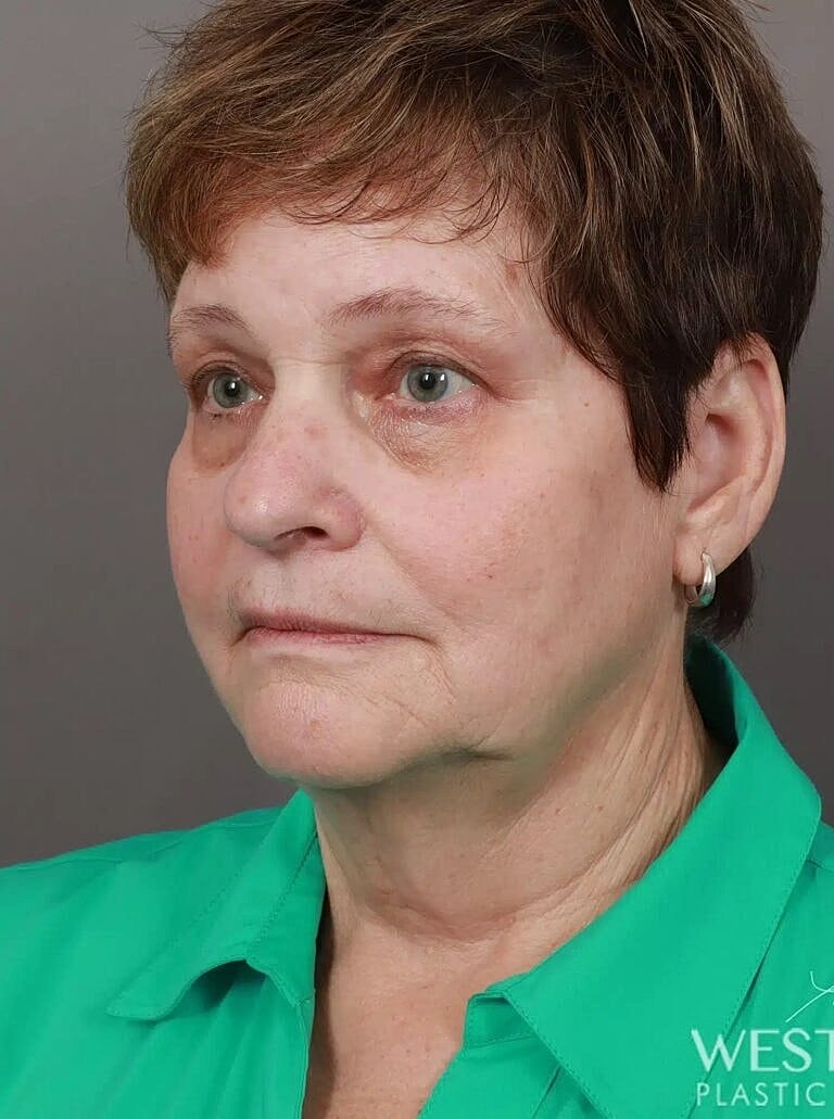 Neck Lift Before & After