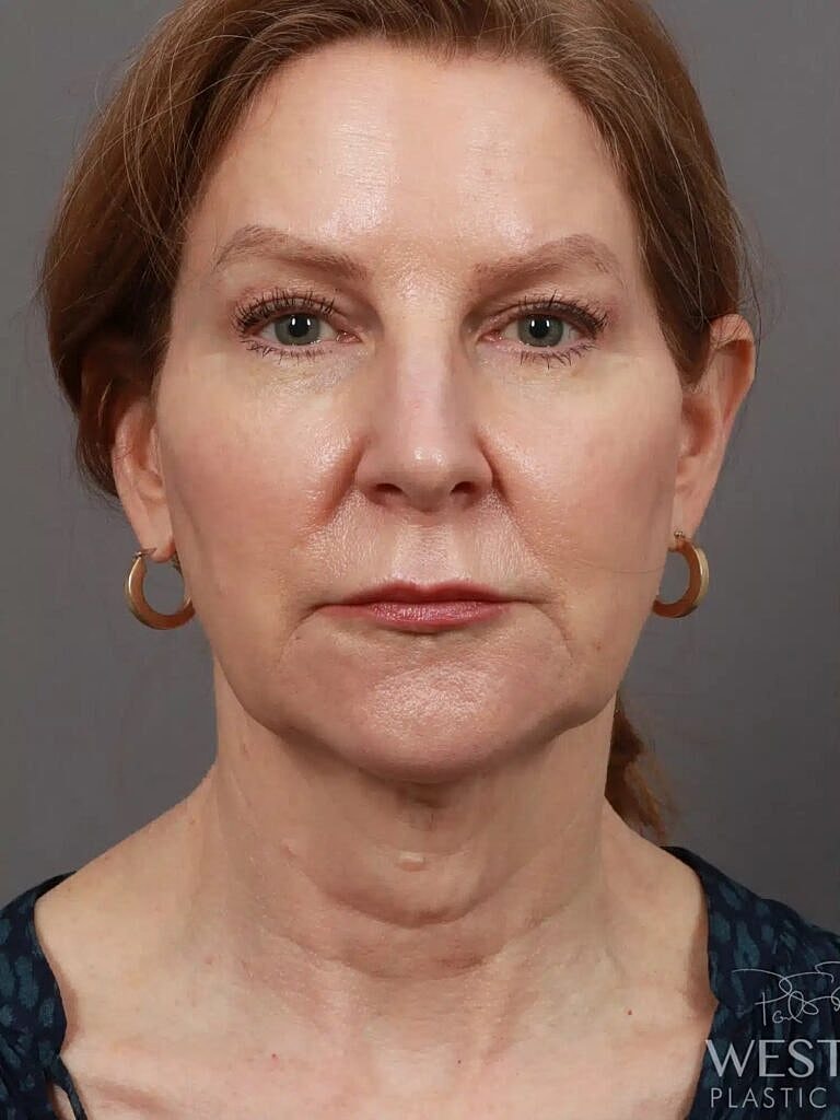 Neck Lift Before & After