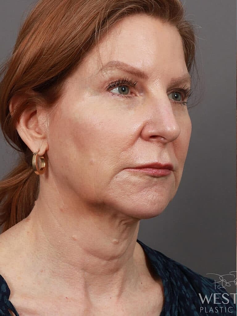 Neck Lift Before & After
